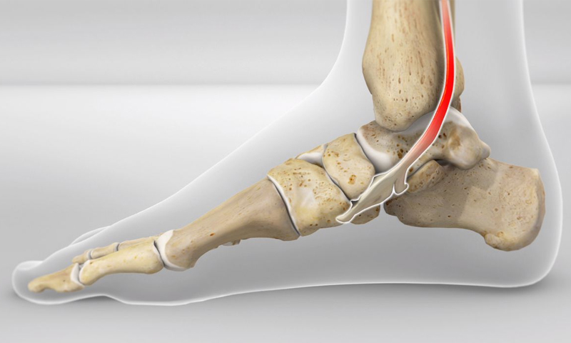 posterior tibial tendonitis